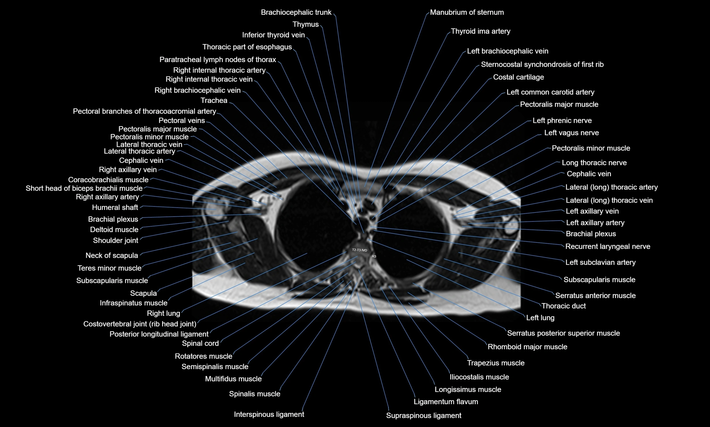 MRI chest axial  cross sectional anatomy 3T radiology  image-img-00001-00011.webp